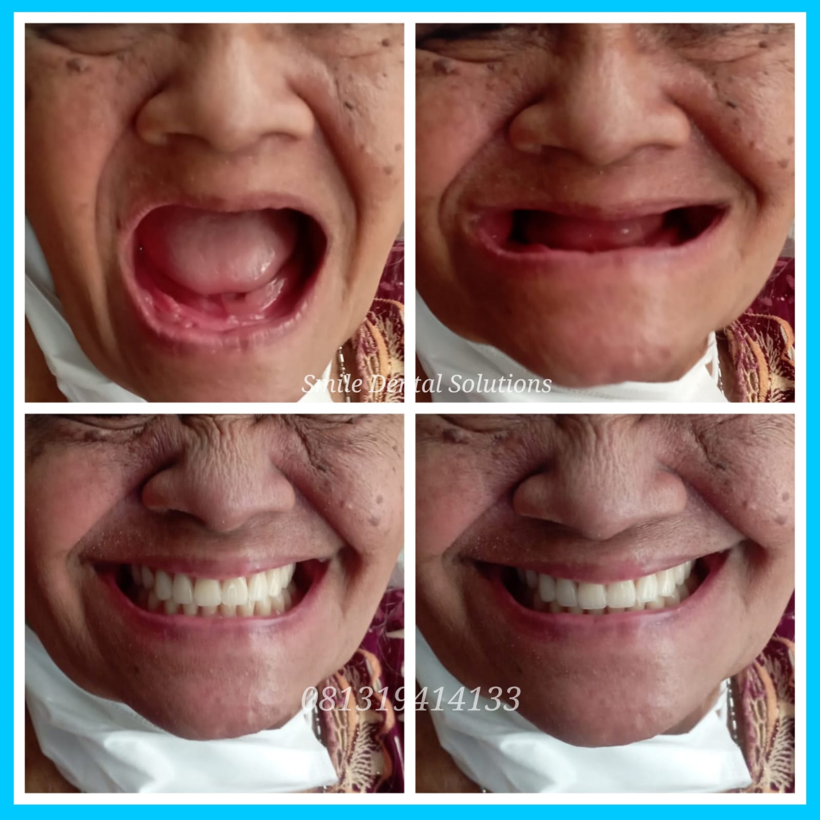 Pasang Gigi Palsu Pondok Indah