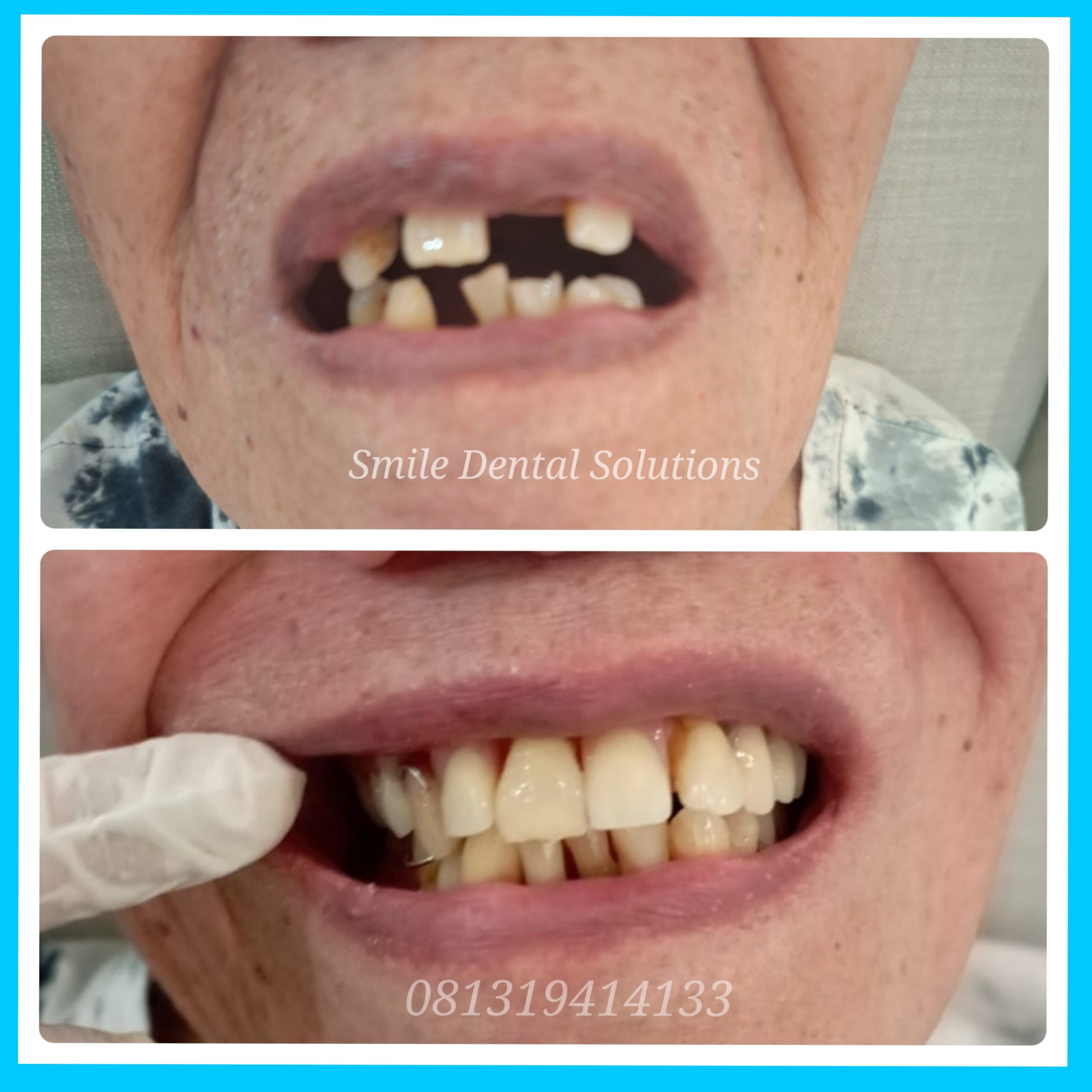 Pasang Gigi Palsu Cibinong