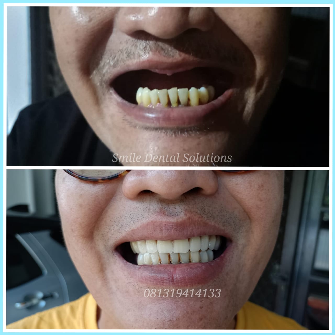 Berapa lama pembuatan gigi palsu valplast